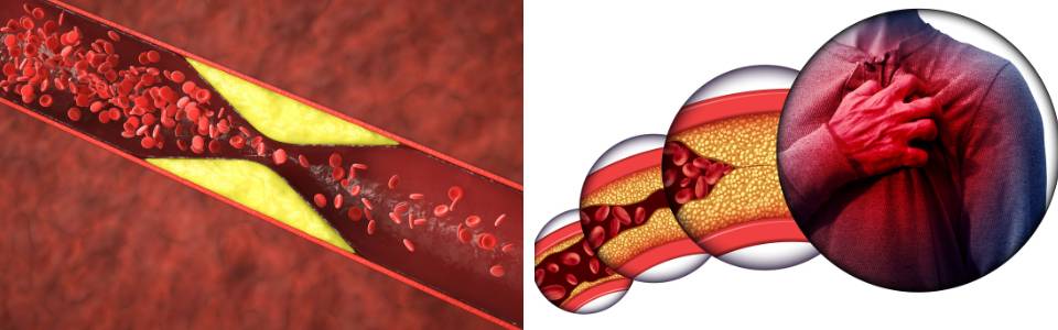 Blocked coronary artery